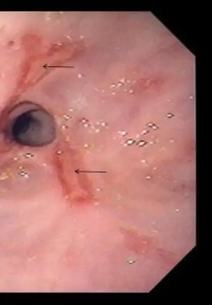 역류성 식도염으로 식도 좁아짐(협착)이 사진은 식도의 좁아짐(협착) 위 식도(화살표) 내부 표면의 식도염/손상도 보여줍니다