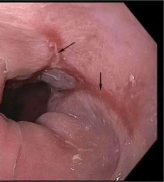 위식도 역류병로 인한 식도염 (영상 제공: Kristle Lynch, MD.)