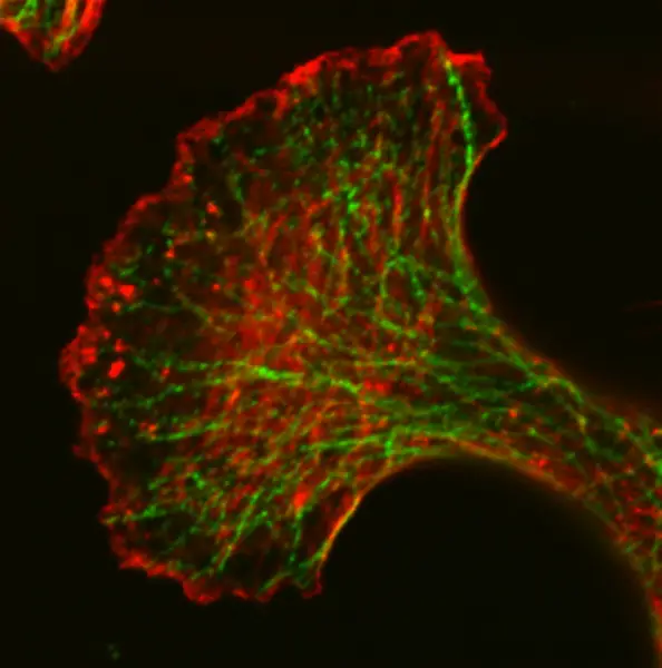 모야모야병의 뇌신경 사진