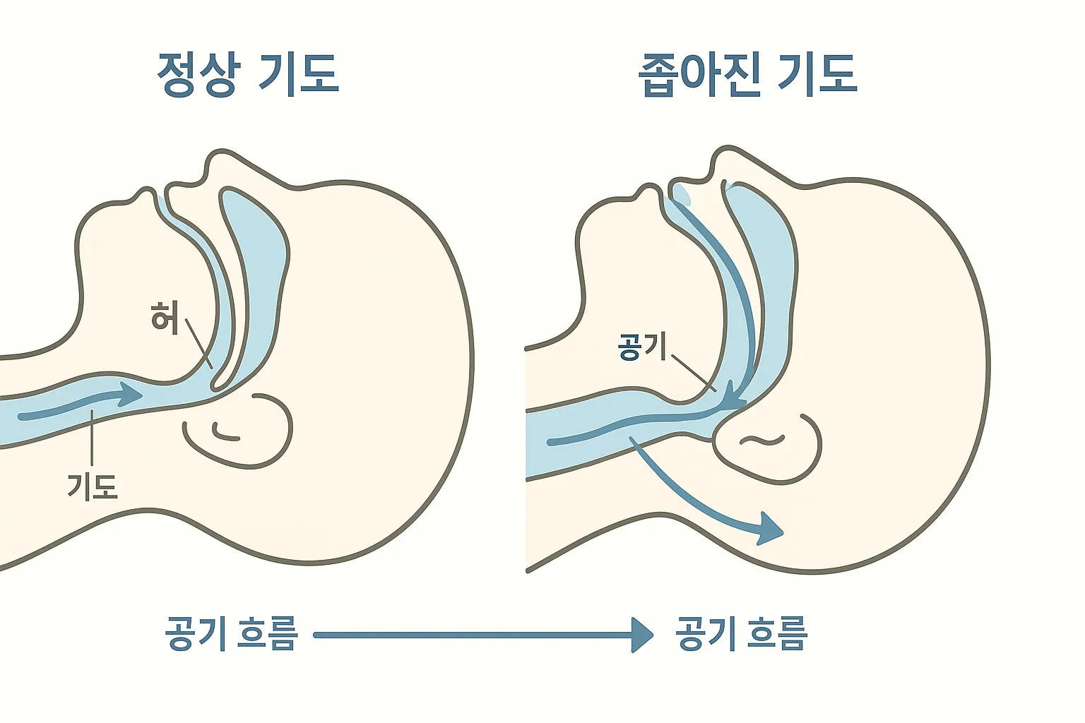 기도가 좁아지는 구조를 단순하게 표현한 수면무호흡 의료 일러스트